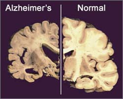 Ảnh chụp cắt lớp não của bệnh nhân Alzheimer (trái) và người không mắc bệnh (phải)